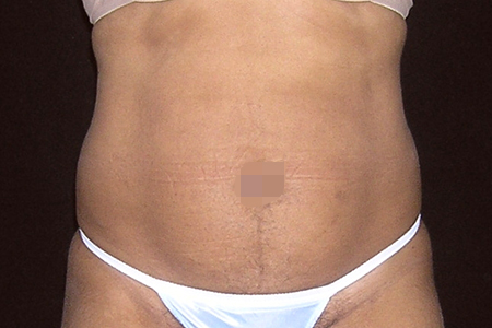 Liposuction Patient 103