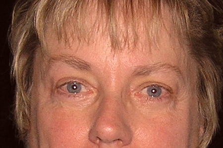 Eyelid Lift Patient 5