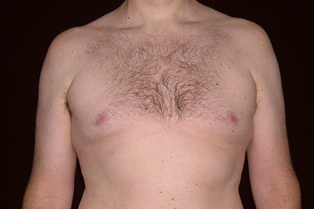 Male Breast Reduction Patient 2