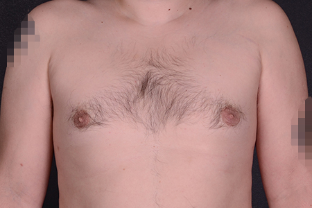Male Breast Reduction Patient 9