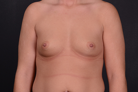 Breast Augmentation Patient 44