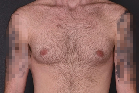 Male Breast Reduction Patient 5
