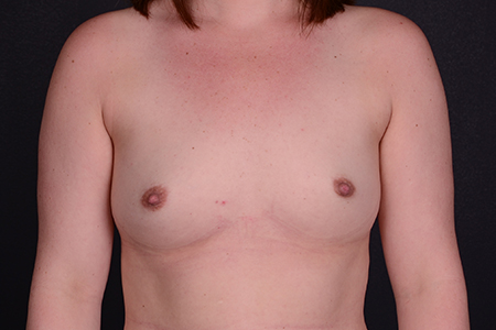 Breast Augmentation Patient 79