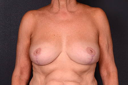 Breast Reduction Patient 16