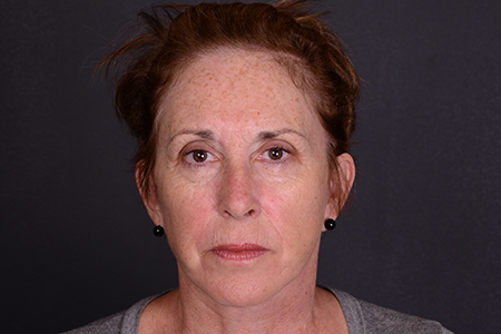 Facelift and Laser Skin Resurfacing Patient 19