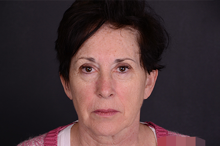 Facelift and Laser Skin Resurfacing Patient 19