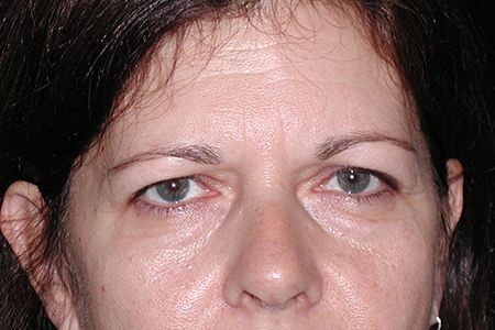 Eyebrow Lift and Eyelid Lift Patient 2