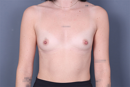 Breast Augmentation Patient 162