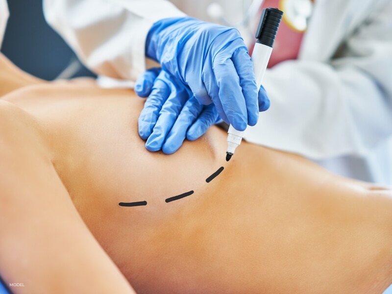 a surgeon marking a patient for a carefully placed incision line hidden under the fold of the breast