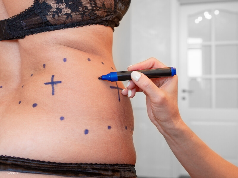 model image of a woman being marked for a liposuction procedure