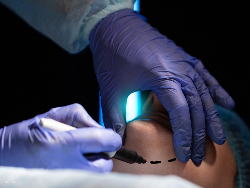 stock image depicting patient being marked by doctor for chin liposuction